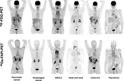 FAPI-PET/CT in Cancer Imaging: A Potential Novel Molecule of the Century